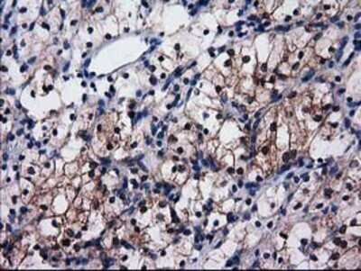Immunohistochemistry: Cytosolic Sulfotransferase 1C2/SULT1C2 Antibody (OTI4G1) - Azide and BSA Free [NBP2-71313] - Staining of paraffin-embedded Carcinoma of Human kidney tissue using anti-SULT1C2 mouse monoclonal antibody.