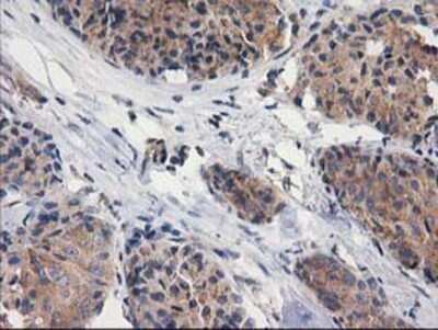 Immunohistochemistry: Cytosolic beta-Glucosidase/GBA3 Antibody (OTI1F1) - Azide and BSA Free [NBP2-72100] - Staining of paraffin-embedded Adenocarcinoma of Human breast tissue using anti-GBA3 mouse monoclonal antibody.