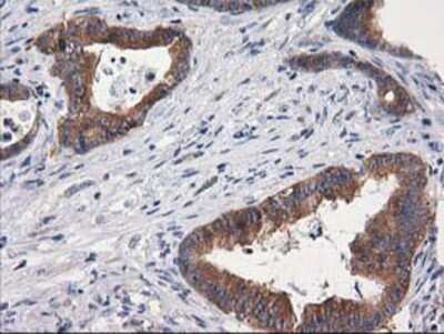 Immunohistochemistry: Cytosolic beta-Glucosidase/GBA3 Antibody (OTI1F1) - Azide and BSA Free [NBP2-72100] - Staining of paraffin-embedded Adenocarcinoma of Human colon tissue using anti-GBA3 mouse monoclonal antibody.