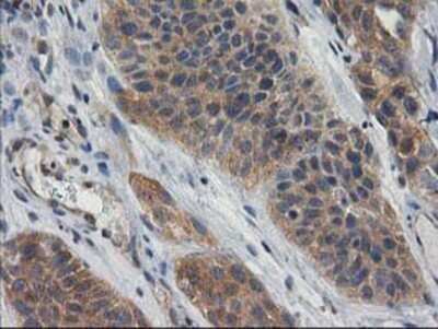 Immunohistochemistry: Cytosolic beta-Glucosidase/GBA3 Antibody (OTI1F1) - Azide and BSA Free [NBP2-72100] - Staining of paraffin-embedded Carcinoma of Human bladder tissue using anti-GBA3 mouse monoclonal antibody.