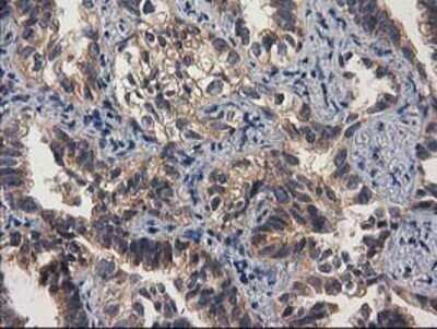 Immunohistochemistry: Cytosolic beta-Glucosidase/GBA3 Antibody (OTI1F1) - Azide and BSA Free [NBP2-72100] - Staining of paraffin-embedded Carcinoma of Human lung tissue using anti-GBA3 mouse monoclonal antibody.