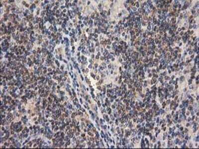 Immunohistochemistry: Cytosolic beta-Glucosidase/GBA3 Antibody (OTI1F1) - Azide and BSA Free [NBP2-72100] - Staining of paraffin-embedded Human lymphoma tissue using anti-GBA3 mouse monoclonal antibody.