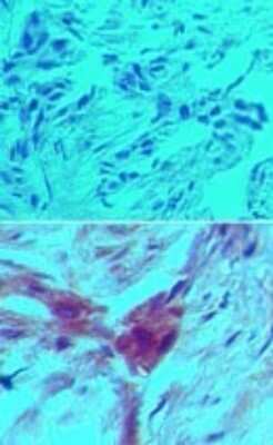 Immunohistochemistry-Paraffin: D4-GDI/RhoGDI2 Antibody (97A1015) - (cleavage specific) - Azide Free [NBP2-33248] - Analysis of D4GD1-cv in formalin-fixed, paraffin-embedded human breast tumor tissue using an isotype control (top) and this antibody. Image from the standard format of this antibody.