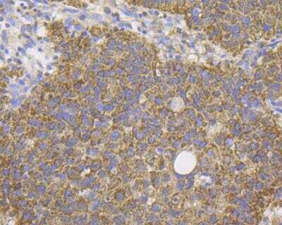 Immunohistochemistry: DAP Kinase 1 Antibody (12B2) [NBP2-76835] - Immunohistochemical analysis of paraffin-embedded human lung cancer tissue using anti-DAP Kinase 1 antibody. The section was pre-treated using heat mediated antigen retrieval with Tris-EDTA buffer (pH 8.0-8.4) for 20 minutes.The tissues were blocked in 5% BSA for 30 minutes at room temperature, washed with ddH2O and PBS, and then probed with the antibody at 1/200 dilution, for 30 minutes at room temperature and detected using an HRP conjugated compact polymer system. DAB was used as the chrogen. Counter stained with hematoxylin and mounted with DPX.