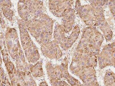 Immunohistochemistry-Paraffin: DAP Kinase 2 Antibody [NBP3-06183] - Immunochemical staining of human DAP Kinase 2 in human hepatoma with rabbit polyclonal antibody at 1:100 dilution, formalin-fixed paraffin embedded sections.