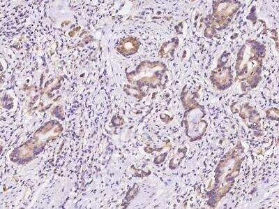 Immunohistochemistry-Paraffin: DAP Kinase 2 Antibody [NBP3-06183] - Immunochemical staining of human DAP Kinase 2 in human gastric cancer with rabbit polyclonal antibody at 1:100 dilution, formalin-fixed paraffin embedded sections.