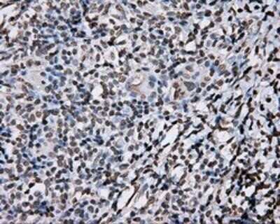 Immunohistochemistry: DAP Kinase 2 Antibody (OTI1C5) - Azide and BSA Free [NBP2-71753] - Staining of paraffin-embedded Carcinoma of Human thyroid tissue using anti-DAP Kinase 2 mouse monoclonal antibody.