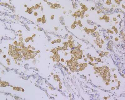 Immunohistochemistry-Paraffin: DAP12 Antibody (JG38-70) [NBP2-76828] - Human lung cancer tissue using anti-DAP12 antibody. Counter stained with hematoxylin.