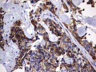 Immunohistochemistry: DAP3 Antibody (1B12) [NBP2-46427] - Analysis of Adenocarcinoma of Human breast tissue. (Heat-induced epitope retrieval by 10mM citric buffer, pH6.0, 120C for 3min)