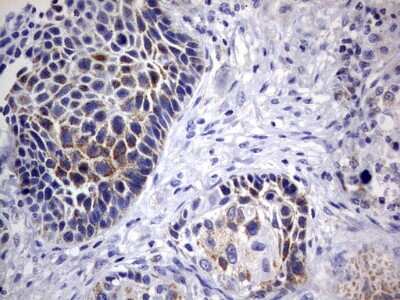 Immunohistochemistry: DAP3 Antibody (1B12) [NBP2-46427] - Analysis of Carcinoma of Human lung tissue.(Heat-induced epitope retrieval by 10mM citric buffer, pH6.0, 120C for 3min)
