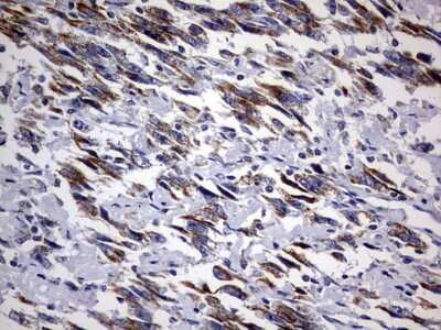 Immunohistochemistry: DAP3 Antibody (1B12) [NBP2-46427] - Analysis of Adenocarcinoma of Human ovary tissue. (Heat-induced epitope retrieval by 10mM citric buffer, pH6.0, 120C for 3min)