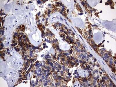 Immunohistochemistry: DAP3 Antibody (OTI1B12) - Azide and BSA Free [NBP2-71338] - Analysis of Adenocarcinoma of Human breast tissue. (Heat-induced epitope retrieval by 10mM citric buffer, pH6.0, 120C for 3min)