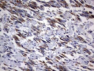 Immunohistochemistry: DAP3 Antibody (OTI1B12) - Azide and BSA Free [NBP2-71338] - Analysis of Adenocarcinoma of Human ovary tissue. (Heat-induced epitope retrieval by 10mM citric buffer, pH6.0, 120C for 3min)