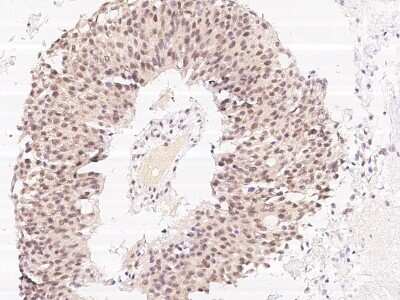 Immunohistochemistry-Paraffin: DAPK3/ZIPK Antibody [NBP2-98766] - Immunochemical staining of human DAPK3/ZIPK in human lung cancer with rabbit polyclonal antibody at 1:1000 dilution, formalin-fixed paraffin embedded sections.