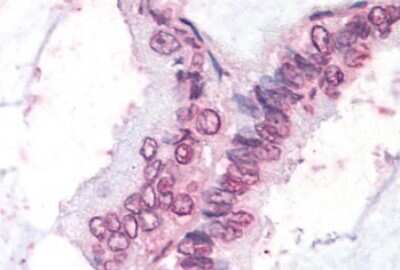 Immunohistochemistry-Paraffin: DAX1/NR0B1 Antibody [NLS5716] - Anti-NR0B1 / DAX1 antibody IHC of human Lung, Non-Small Cell Carcinoma. Immunohistochemistry of formalin-fixed, paraffin-embedded tissue after heat-induced antigen retrieval.