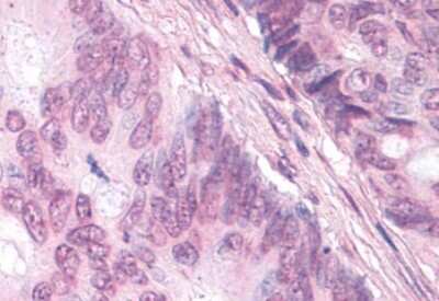 Immunohistochemistry-Paraffin: DAX1/NR0B1 Antibody [NLS5716] - Anti-NR0B1 / DAX1 antibody IHC of human Colon, Carcinoma. Immunohistochemistry of formalin-fixed, paraffin-embedded tissue after heat-induced antigen retrieval.