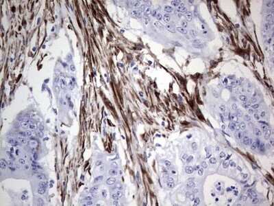 Immunohistochemistry: DAX1/NR0B1 Antibody (OTI5F5) - Azide and BSA Free [NBP2-70116] - Analysis of Adenocarcinoma of Human colon tissue. (Heat-induced epitope retrieval by 1 mM EDTA in 10mM Tris, pH8.5, 120C for 3min)