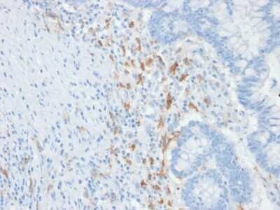 Immunohistochemistry-Paraffin: DC-SIGN/CD209 Antibody (C209/1781) - Azide and BSA Free [NBP2-54351] - Formalin-fixed, paraffin-embedded human Colon Carcinoma stained with CD209 Monoclonal Antibody (C209/1781).