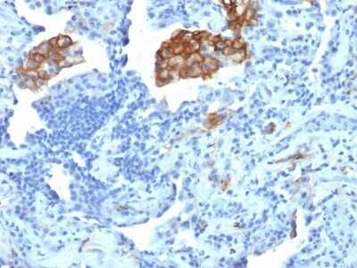 Immunohistochemistry-Paraffin: DC-SIGN/CD209 Antibody (C209/1781) - Azide and BSA Free [NBP2-54351] - Formalin-fixed, paraffin-embedded human Lung Carcinoma stained with CD209 Monoclonal Antibody (C209/1781).