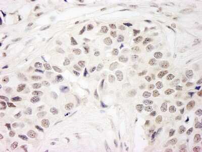 Immunohistochemistry: DC8 Antibody [NB100-2575] - Sample: FFPE section of human breast carcinoma. Antibody: Affinity purified rabbit anti-DC8 used at a dilution of 1:1,000 (1ug/ml). Detection: DAB