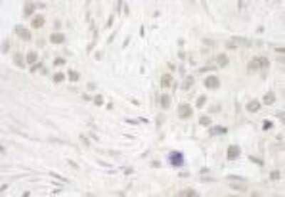 Immunohistochemistry-Paraffin: DC8 Antibody [NB100-2575] - FFPE section of human breast carcinoma.  Affinity purified rabbit anti-DC8 used at a dilution of 1:250.