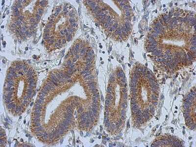 Immunohistochemistry-Paraffin: DCBLD2 Antibody [NBP2-16105] - Immunohistochemical analysis of paraffin-embedded Colon ca, using antibody at 1:500 dilution.