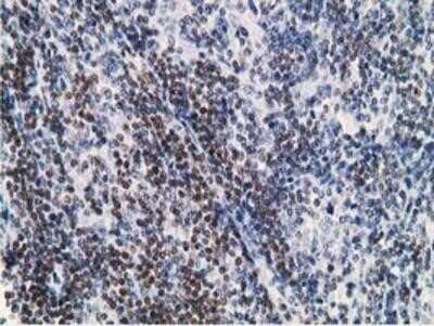 Immunohistochemistry: DCK Antibody (OTI3F5) - Azide and BSA Free [NBP2-70555] - Staining of paraffin-embedded Human lymphoma tissue using anti-DCK mouse monoclonal antibody.