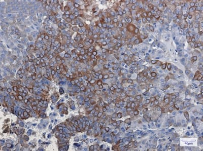 Immunohistochemistry-Paraffin: DCLK1 Antibody (S05-8D6) [NBP3-19952] - Immunohistochemistry of DCLK1 in paraffin-embedded Human breast cancer tissue using NBP3-19952 at dilution 1/50