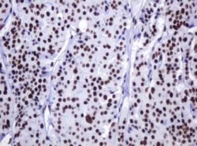 Immunohistochemistry: DCPS Antibody (4H8) [NBP2-45650] - Analysis of Carcinoma of Human thyroid tissue. (Heat-induced epitope retrieval by 10mM citric buffer, pH6.0, 120C for 3min)