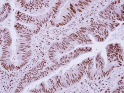 Immunohistochemistry-Paraffin: DCPS Antibody [NBP2-16110] - Immunohistochemical analysis of paraffin-embedded Colon ca, using antibody at 1:250 dilution.