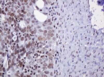 Immunohistochemistry: DCPS Antibody (OTI4H8) - Azide and BSA Free [NBP2-71839] - Analysis of Adenocarcinoma of Human ovary tissue. (Heat-induced epitope retrieval by 10mM citric buffer, pH6.0, 120C for 3min)