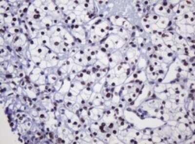 Immunohistochemistry: DCPS Antibody (OTI4H8) - Azide and BSA Free [NBP2-71839] - Analysis of Carcinoma of Human kidney tissue. (Heat-induced epitope retrieval by 10mM citric buffer, pH6.0, 120C for 3min)