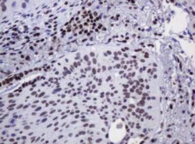 Immunohistochemistry: DCPS Antibody (OTI4H8) - Azide and BSA Free [NBP2-71839] - Analysis of Carcinoma of Human lung tissue.(Heat-induced epitope retrieval by 10mM citric buffer, pH6.0, 120C for 3min)
