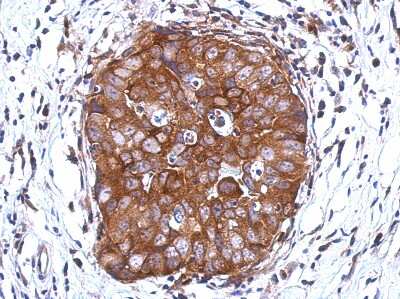 Immunohistochemistry-Paraffin: DCUN1D2 Antibody [NBP2-16118] - Human breast cancer, using DCUN1D2 antibody at 1:500 dilution. Antigen Retrieval: Trilogy™ (EDTA based, pH 8.0) buffer, 15min.