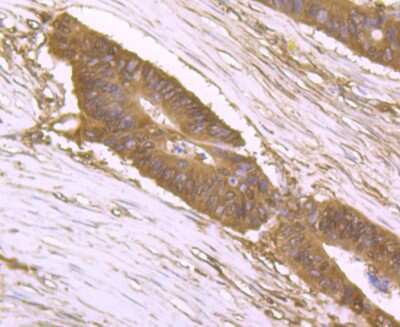 Immunohistochemistry-Paraffin: DDIT4 Antibody [NBP2-80416] - Analysis in human colon cancer tissue using DDIT4 antibody. Counter stained with hematoxylin.