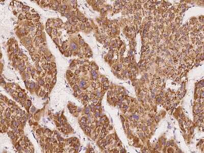 Immunohistochemistry-Paraffin: DDOST Antibody [NBP2-99995] - Immunochemical staining of human DDOST in human hepatoma with rabbit polyclonal antibody at 1:1000 dilution, formalin-fixed paraffin embedded sections.