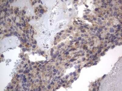 Immunohistochemistry: DDOST Antibody (OTI2B4) - Azide and BSA Free [NBP2-70561] - Analysis of Adenocarcinoma of Human breast tissue. (Heat-induced epitope retrieval by 1 mM EDTA in 10mM Tris, pH8.5, 120C for 3min)