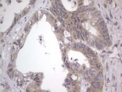 Immunohistochemistry: DDOST Antibody (OTI2B4) - Azide and BSA Free [NBP2-70561] - Analysis of Adenocarcinoma of Human colon tissue. (Heat-induced epitope retrieval by 1 mM EDTA in 10mM Tris, pH8.5, 120C for 3min)