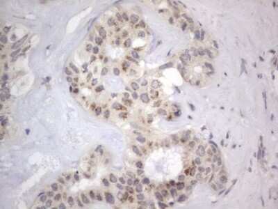 Immunohistochemistry: DDOST Antibody (OTI2B4) - Azide and BSA Free [NBP2-70561] - Analysis of Carcinoma of Human liver tissue.(Heat-induced epitope retrieval by 1 mM EDTA in 10mM Tris, pH8.5, 120C for 3min)