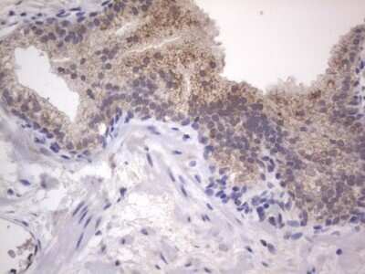 Immunohistochemistry: DDOST Antibody (OTI2B4) - Azide and BSA Free [NBP2-70561] - Analysis of Carcinoma of Human prostate tissue. (Heat-induced epitope retrieval by 1 mM EDTA in 10mM Tris, pH8.5, 120C for 3min)