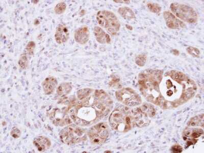 Immunohistochemistry-Paraffin: DDT Antibody [NBP1-33461] - Paraffin-embedded NCIN87 xenograft, using antibody at 1:100 dilution.