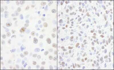 Immunohistochemistry: DDX21 Antibody [NB100-1718] - Sample: FFPE section of human breast carcinoma (left) and mouse squamous cell carcinoma (right). Antibody: Affinity purified rabbit anti-DDX21 used at a dilution of 1:200 (1ug/ml). Detection: DAB.