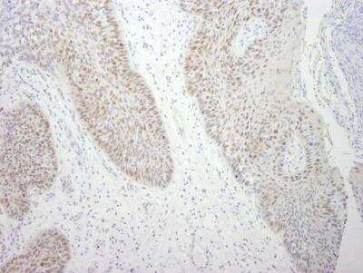 Immunohistochemistry-Paraffin: DDX21 Antibody [NB100-1718] - FFPE section of human larynx squamous cell carcinoma.  Antibody used at a dilution of 1:250. Detection: DAB staining using Immunohistochemistry Accessory Kit.