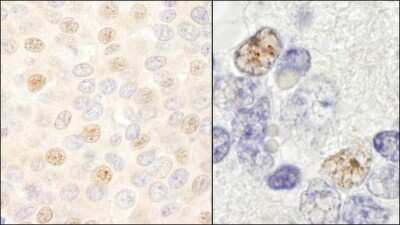 <b>Independent Antibodies Validation and Biological Strategies Validation.</b>Immunohistochemistry-Paraffin: DDX46 Antibody [NB100-57490] - Sample: FFPE section of human breast carcinoma (left) and mouse teratoma (right). Antibody: Affinity purified rabbit anti-DDX46 used at a dilution of 1:200 ( 1ug/ml). Detection: DAB