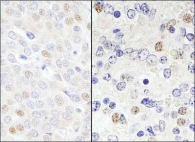 Immunohistochemistry-Paraffin: DDX46 Antibody [NB100-57489] - Human breast carcinoma (left) and mouse teratoma (right).  Antibody used at a dilution of 1:1,000 (0.2ug/ml).