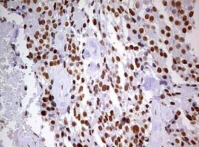 Immunohistochemistry: DDX56 Antibody (OTI2E5) - Azide and BSA Free [NBP2-71964] - Analysis of Adenocarcinoma of Human breast tissue. (Heat-induced epitope retrieval by 10mM citric buffer, pH6.0, 120C for 3min)