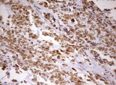 Immunohistochemistry: DDX56 Antibody (OTI2E5) - Azide and BSA Free [NBP2-71964] - Analysis of Adenocarcinoma of Human endometrium tissue. (Heat-induced epitope retrieval by 10mM citric buffer, pH6.0, 120C for 3min)