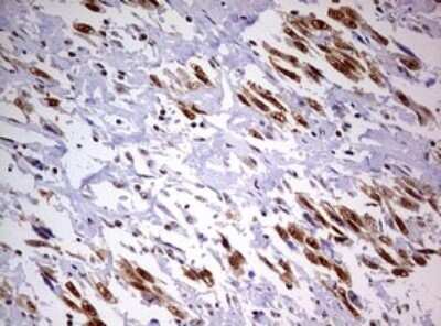 Immunohistochemistry: DDX56 Antibody (OTI2E5) - Azide and BSA Free [NBP2-71964] - Analysis of Adenocarcinoma of Human ovary tissue. (Heat-induced epitope retrieval by 10mM citric buffer, pH6.0, 120C for 3min)