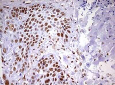 Immunohistochemistry: DDX56 Antibody (OTI2E5) - Azide and BSA Free [NBP2-71964] - Analysis of Carcinoma of Human lung tissue. (Heat-induced epitope retrieval by 10mM citric buffer, pH6.0, 120C for 3min)