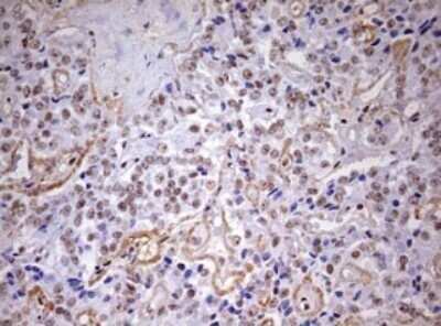 Immunohistochemistry: DDX56 Antibody (OTI2E5) - Azide and BSA Free [NBP2-71964] - Analysis of Carcinoma of Human pancreas tissue. (Heat-induced epitope retrieval by 10mM citric buffer, pH6.0, 120C for 3min)